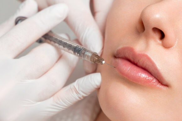 Dermal Fillers
